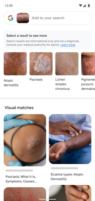 Google Lens can now search for skin conditions | SBM Global News