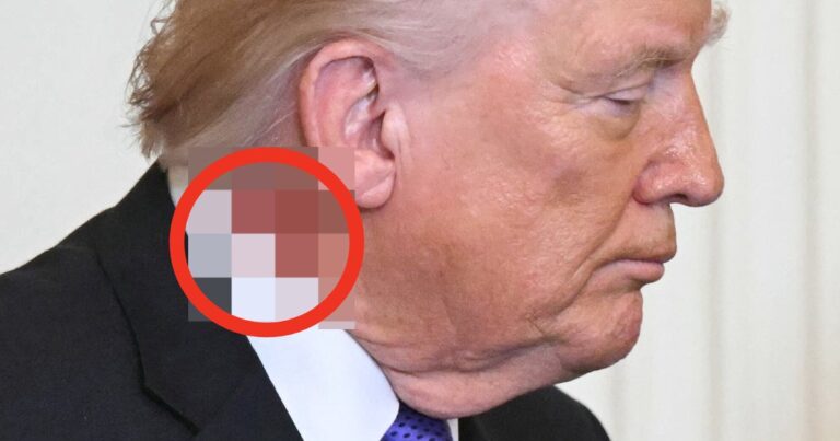 WhatsUpWithTrumpsAngryNeckRashWeAskedThejpeg | SBM Global News